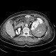 Renal hemorrhage, staghorn calculus: CT - Computed tomography
